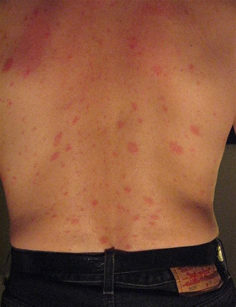 Pityriasis Rosea Concise Medical Knowledge