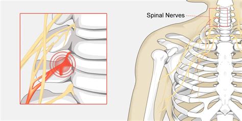 Review Of How To Release A Trapped Nerve In Shoulder Blade Ideas