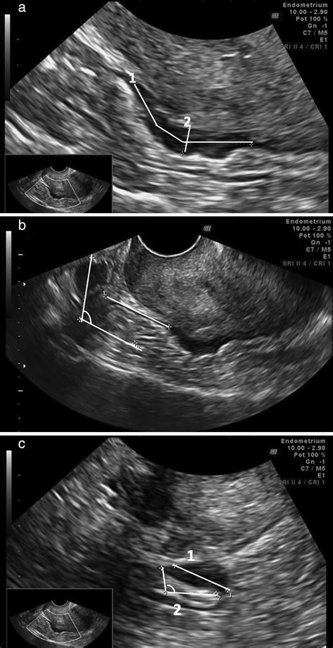 bowel preparation prior to transvaginal ultrasound improves detection hot sex picture