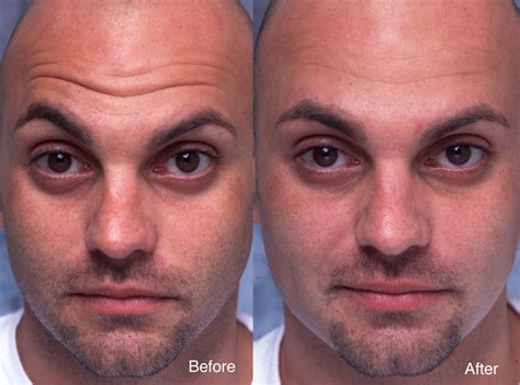 Botox® is used for both aesthetic and therapeutic treatments. Botox Case Studies Beverly Hills | Dysport Beverly Hills | LidLift