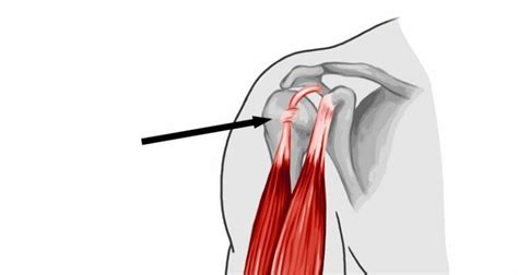 Long Head Bicep Tendon Tear At Shoulder Causes Symptoms And Treatments