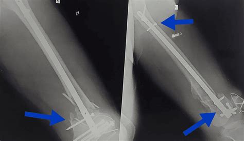 Cureus Effect Of Physiotherapy On A Rare Case Of Malunion Of Femur