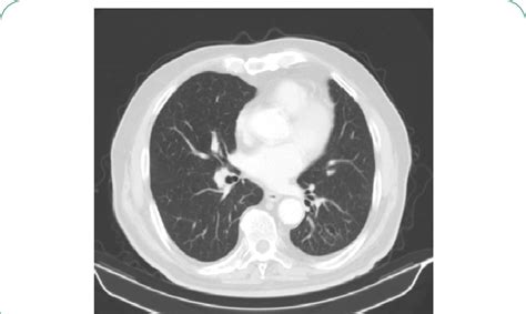 Contrast Enhancement Ct Scan Of The Chest Lung Without Pathological