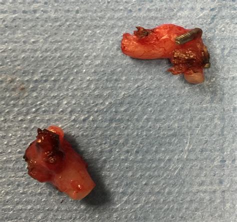 Vasectomy is the least invasive permanent and effective form of birth control, said dr. Reversal: Does it matter which type of vasectomy was done? - Georgia Vasectomy/Vasectomy ...