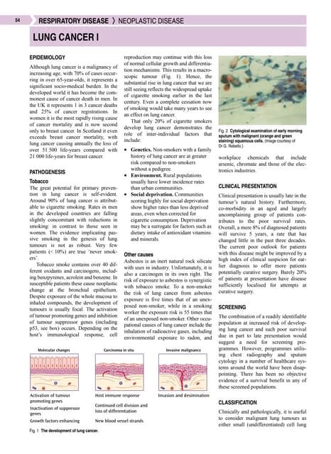 Lung Cancer Primary And Metastatic Pdf