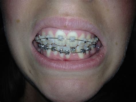 Getting Everything Straight My Double Jaw Surgery Lower Braces Are On
