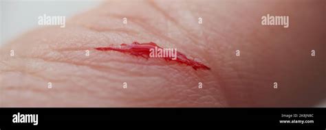 Man With Injured Finger Bleeding Blood On Open Cut Wound Stock Photo