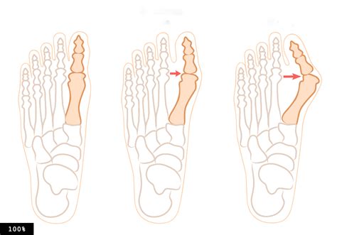 Valgus Deformity Of The Big Toe Of The Foot Bunion Hallux Valgus