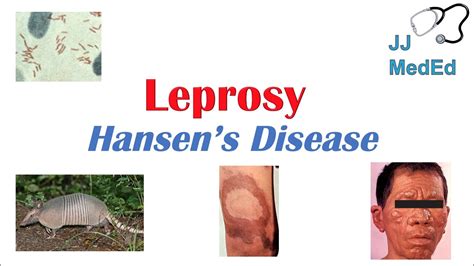 Leprosy Hansens Disease Who Is At Risk Signs And Symptoms