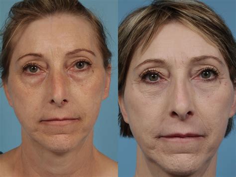 Eyelid Surgery Blepharoplasty In Chicago Dr Thomas Mustoe And Dr