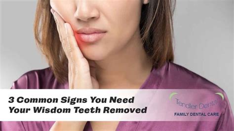 3 Common Signs You Need Your Wisdom Teeth Removed Tendler Dental