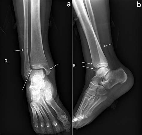 Cureus Combined Tillaux And Bimalleolar Ankle Fracture In A Pediatric