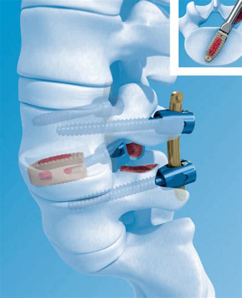 Depuy Synthes Medtronic Leads Europe Mis Interbody Device Market
