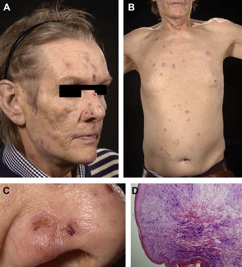 Regression Of Paraneoplastic Rash After Lung Cancer Chemotherapy