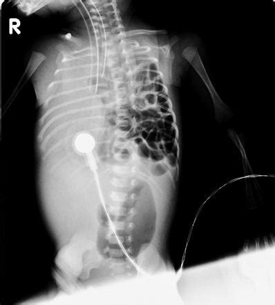 Congenital Diaphragmatic Hernia Radiology Reference Article