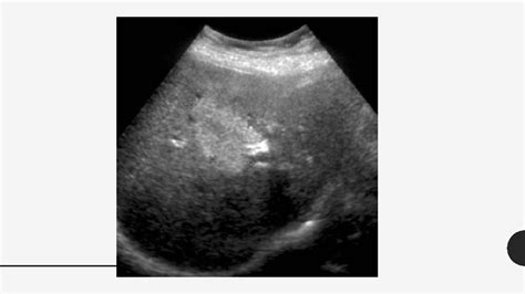 Solitary Thyroid Nodule Approach History The Most Common