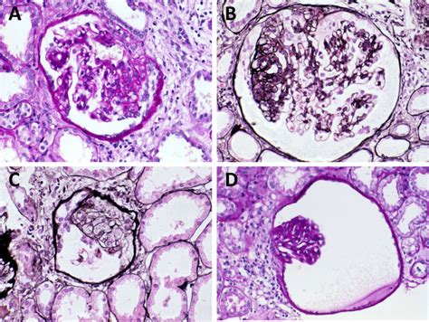 Pkd Associated Autosomal Dominant Polycystic Kidney Disease With Glomerular Cysts Presenting