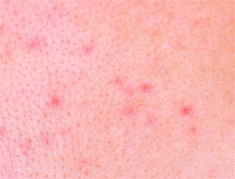 Seasonal Allergies Skin Rash