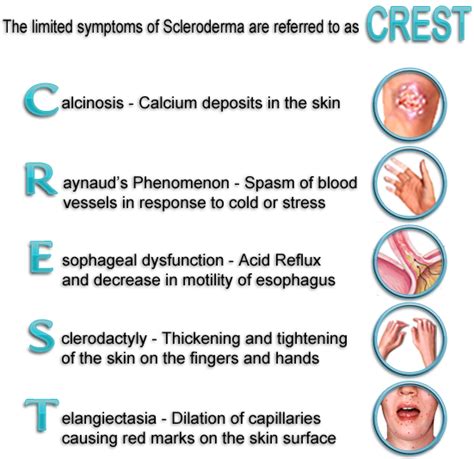 Crest Syndrome A Form Of Scleroderma That Is A Combination Of