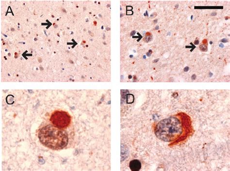 Ubiquitin Immunoreactive Neuronal Cytoplasmic Inclusions In Deep Layers