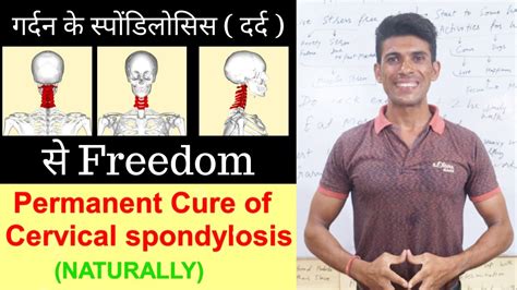 Permanent Cure Of Cervical Spondylosis By Dr Vinod Kumar Hindi