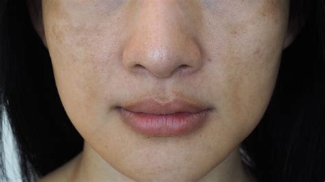Does Your Melasma Make You Avoid The Sun We Can Help Laser Aesthetic