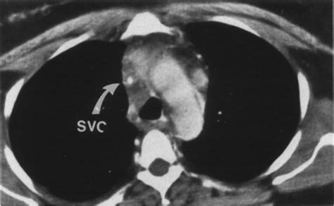 The most common cause of svc obstruction is malignancy, typically from lung cancer, lymphoma, or metastatic disease. Figure 2 from CT findings in superior vena cava ...