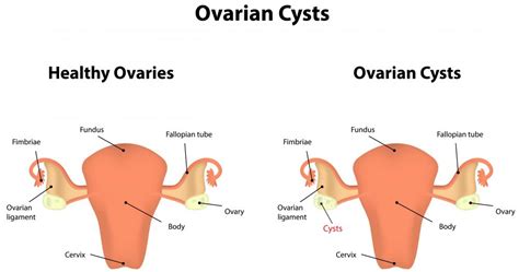 What Causes A Bleeding Ovarian Cyst With Pictures