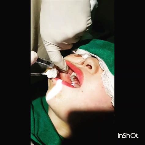 Buccal Fat Pad Removal Surgery GRAPHIC Video RealSelf