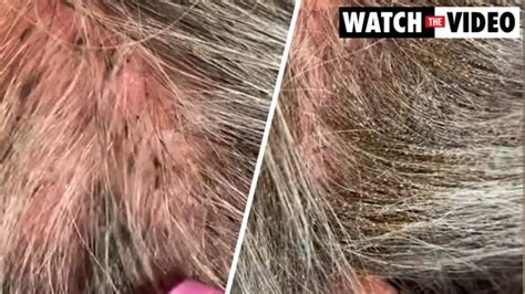 The Lice Angels Experts Reveal Woman With ‘worst Case Of Head Lice