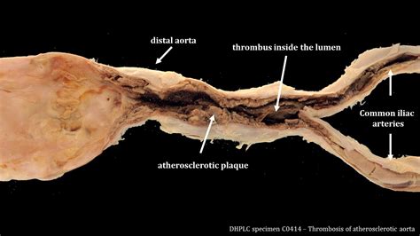 Gross Anatomy And Histopathology Of Atherosclerosis Pathology