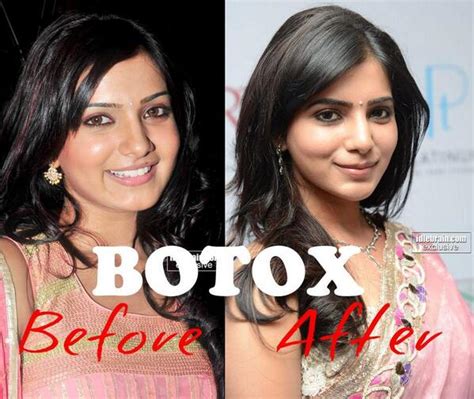 Kashyap Karan On Twitter Samantha Ruth Prabhu Before And After Botox