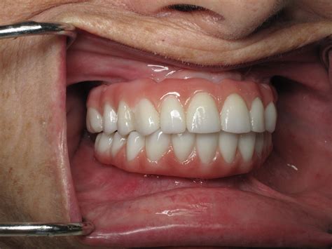 The Process Of “permanent” Fixed Dental Implant Teeth 5 Steps To