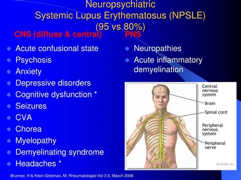 Ppt Systemic Lupus Erythematosus Powerpoint Presentation Free