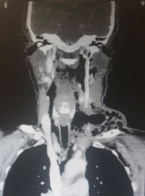 Cureus Fungal Cervical Abscess Complicated By Necrotizing Fasciitis