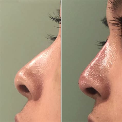 Non Surgical Nose Job In Nyc Rhinoplasty For Men And Women In