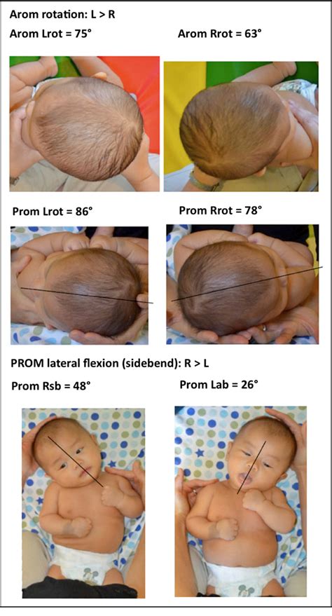 Congenital Muscular Torticollis And Positional Plagiocephaly