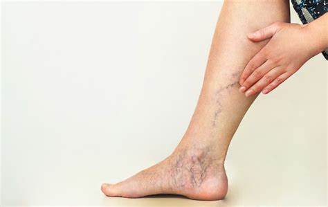 What You Need To Know About Venous Insufficiency One Can Happen