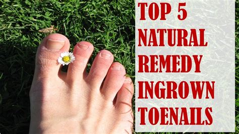 Top 5 Natural Remedies For Ingrown Toenails Youtube
