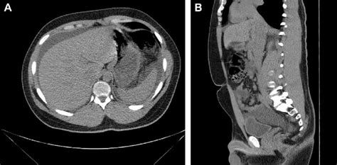 E A Transverse Slice Of Ct Abdomen Without Contrast On Day 1 Showing
