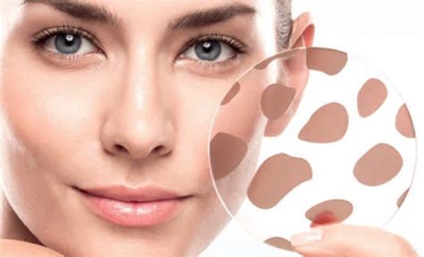 How To Remove Dark Spots On Face 9 Remedies That Work