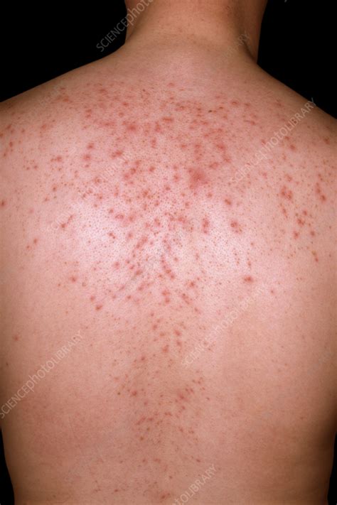Prickly Heat Rash On A Mans Back Stock Image C0585871 Science