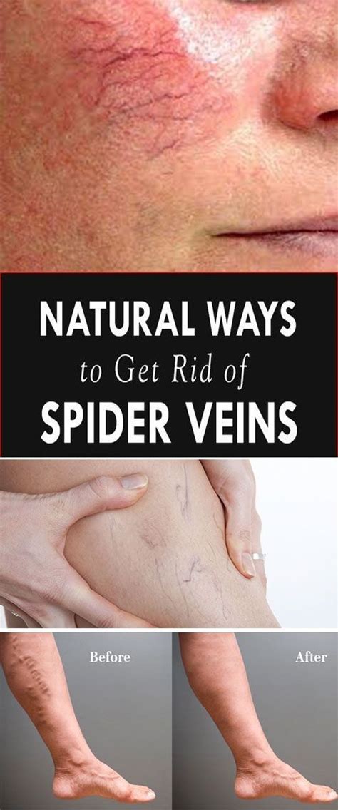 3 Natural Ways To Get Rid Of Spider Veins Get Rid Of Spider Veins