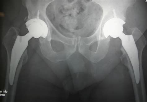 Anterior Total Hip Replacement Scottsdale Joint Center