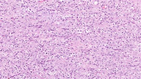 Pathology Outlines Granulosa Cell Tumor Juvenile