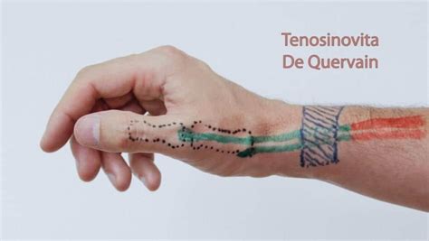 De Quervains Tenosynovitis Mississauga And Oakville Chiropractor And