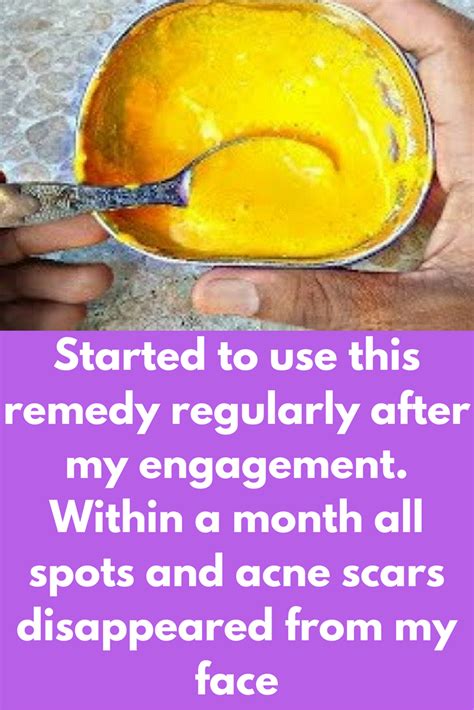 Pin On Oily Skin And Acne