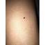 Skin Cancer 24F Mole Showed Up 10 Months Ago  Dermatology
