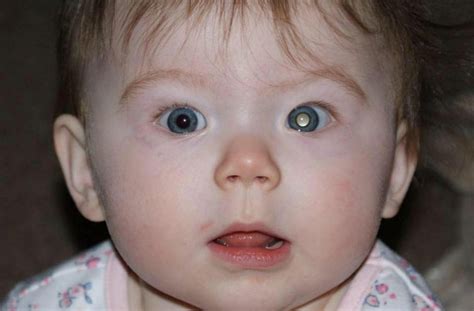 Symptoms Of Eye Cancer In Child Seen A White Glow In A Photo