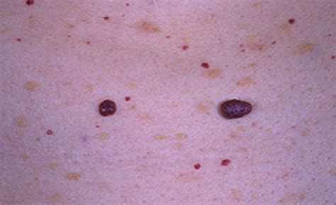 Cherry angiomas are noncancerous red bumps that form due to the clustering of blood vessels on the skin. Dermatology Flashcards by ProProfs